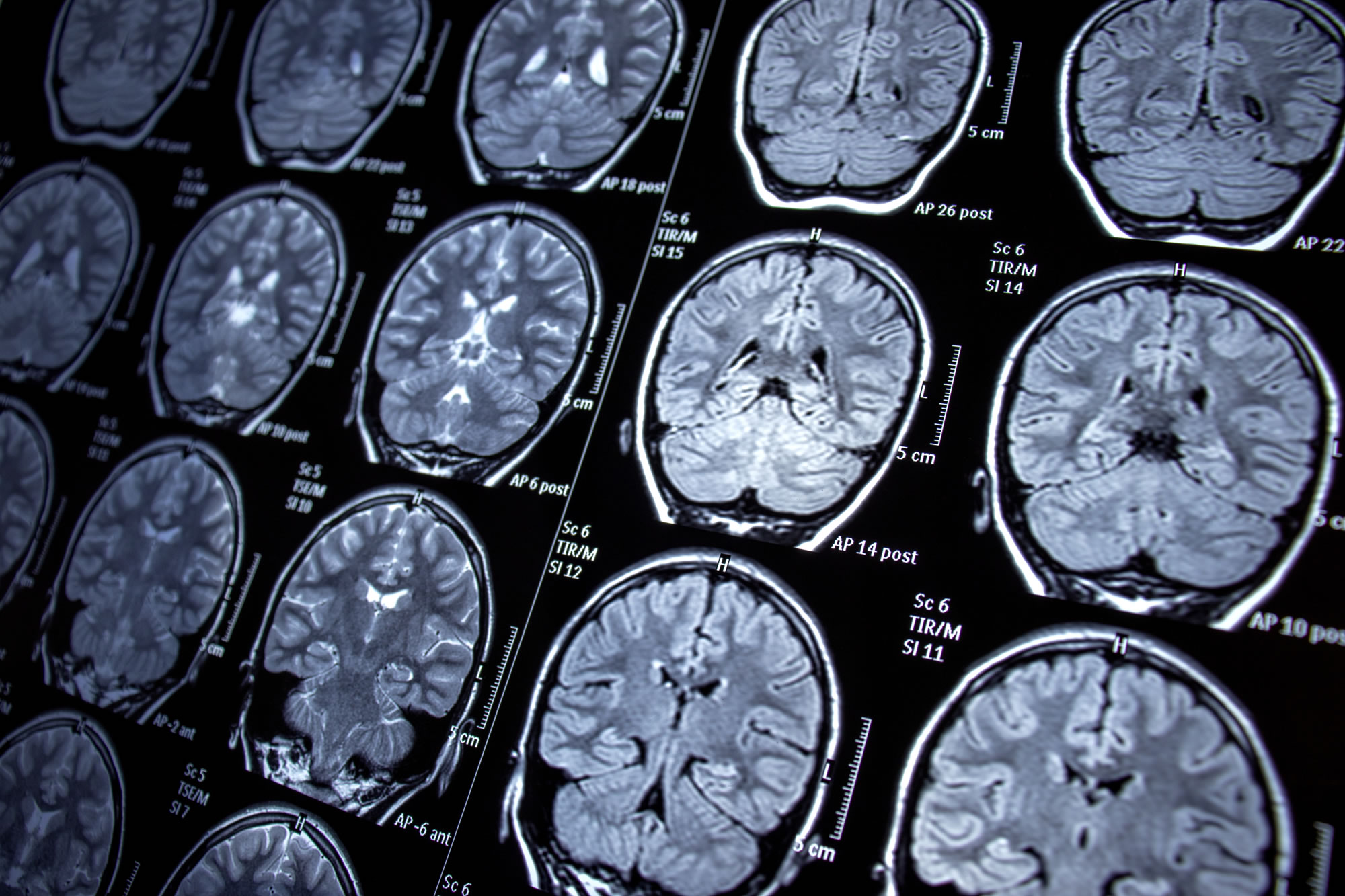 brain-scanning-technique-detecting-concussions